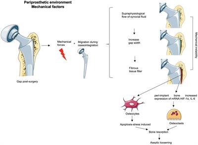 Roles of inflammatory cell infiltrate in periprosthetic osteolysis